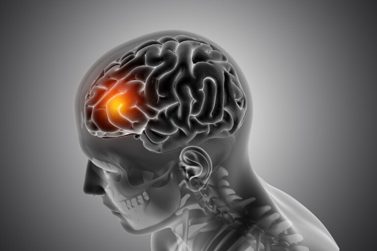 Accidente cerebro vascular – Salud para todo en Teleamiga