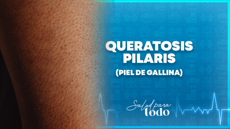 Queratosis pilaris (piel de gallina) – Salud para Todo en Teleamiga